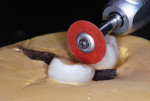 The third molar was cut away and the primary molar surface reduced with an aluminum oxide disk.