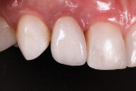 Fig 15. Cemented restoration on a custom zirconia/tibase abutment at 2-month follow-up.