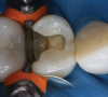 Figure 13  ENDODONTIC AND ESTHETIC PARAMETERS It appears that if choosing between the therapies of surgical versus non-surgical to retain teeth, endodontic surgery offers more favorable initial success, but non-surgical re-treatment offers a more favorable long-term outcome.