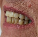 Fig 25. The final denture in the patient’s mouth.