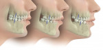 Class I occlusion (left) is simpler to work with, but Class II (center) and Class III (right) situations require more expertise on the part of the dental technician.
