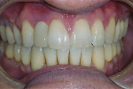 Fig 12. An e.max temporary crown was placed during the same appointment as the placement of the custom abutment prior to in-office whitening and Class V restorations.