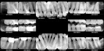 Fig 14. Full-mouth radiographs after clear aligner treatment.