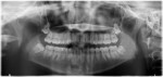 Fig 1. Case 1. Preoperative panoramic radiograph for removal of third molars. Note the proximity of the IAN canal and darkening of the apical third of the roots of teeth Nos. 17 and 32.