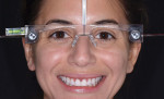 Full face smile and retracted photographs of the provisionalized patient wearing facial reference glasses were taken to communicate the correct midline and shade of the final veneers to the laboratory.