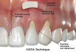 Fig 5. Comparative illustrations of minimally invasive CAF surgical techniques for the correction of gingival recession defects based on review of original articles describing the techniques. VISTA technique is shown. (red dotted line = sulcular incision; green dotted line = coronally advanced flap) (rhPDGF-BB = recombinant human platelet-derived
growth factor-BB) (Illustrations by BroadcastMed LLC based on original concept art by Jessica M. Latimer, DDS.)