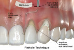 Fig 5. Comparative illustrations of minimally invasive CAF surgical techniques for the correction of gingival recession defects based on review of original articles describing the techniques. Pinhole technique is shown. (green dotted line = coronally advanced flap) (ADM = acellular dermal matrix) (Illustrations by BroadcastMed LLC based on original concept art by Jessica M. Latimer, DDS.)