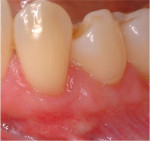 Fig 3. Clinical case highlighting the use of tunneling technique in the posterior mandibular arch with a soft-tissue alternative, ie, acellular dermal matrix, considering the limited amount of keratinized tissue present and the frenum attachment. Post-treatment.