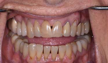 Immediate Dental Implants for Anterior Tooth Replacement in Older Patients