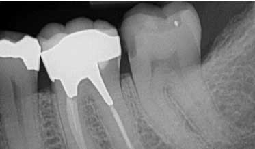 Considerations for the Placement of Endodontic Posts
