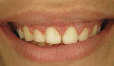 Treating Excessive Gingival Display Without Orthognathic Surgery