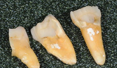 Custom Healing Abutment Fabrication Using Extracted Teeth