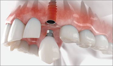 Maintaining Dental Implant Health