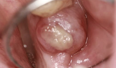 Diagnosing Oral Granulomatous Lesions: A Case Report