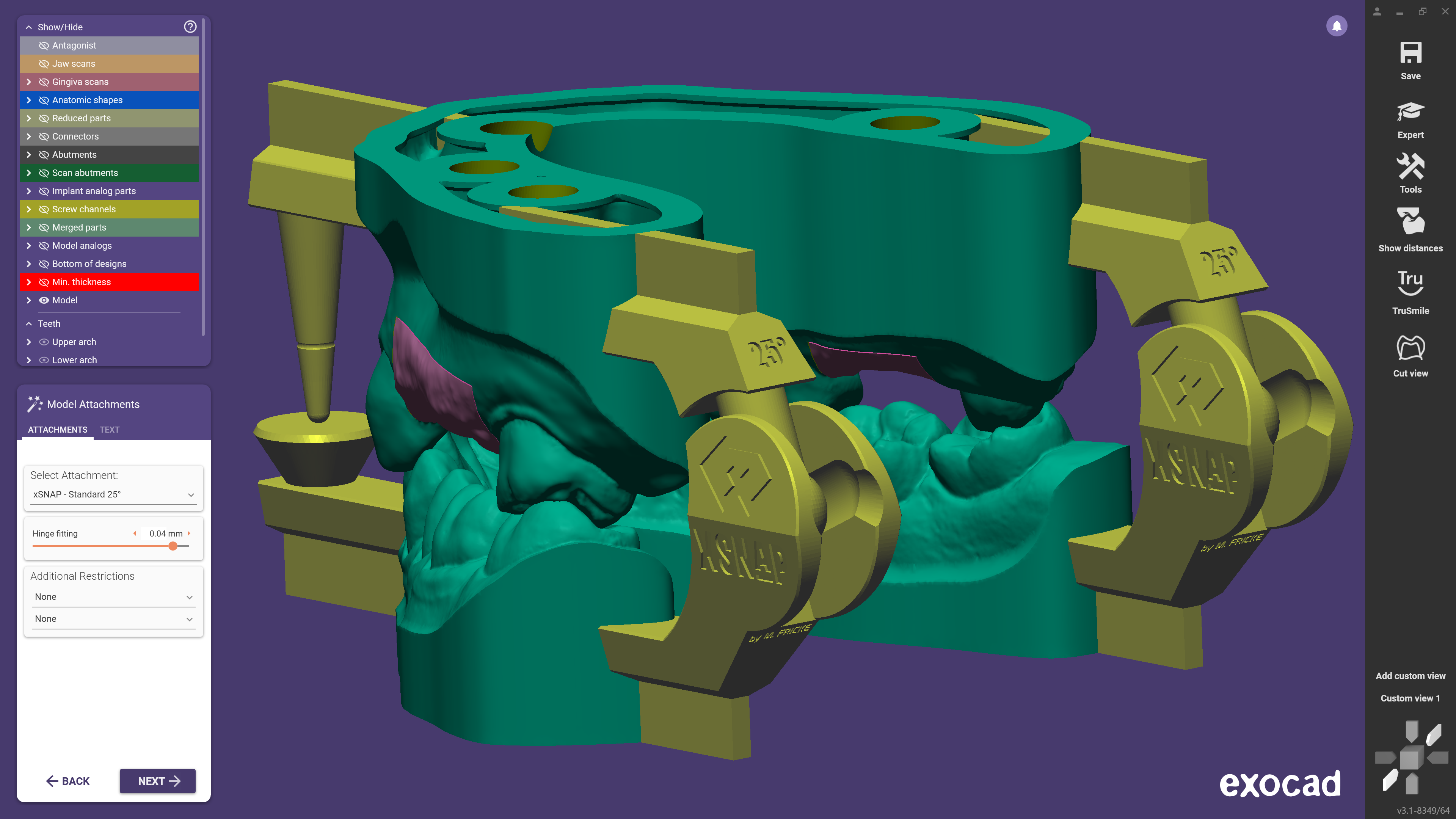 xSNAP Is exocad’s New AddOn Module For Printable Articulators Aegis