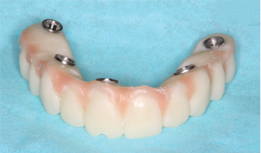 Immediate Implant Placement, Immediate Load With Same-Day Fully Digital Fabrication of a Screw-Retained Provisional Implant Prosthesis
