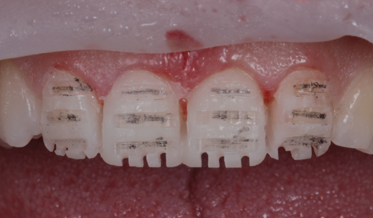 A Conservative Treatment to Address Functional and Esthetic Concerns Adolescents