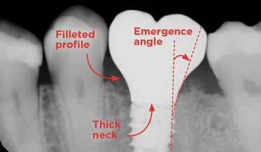 Using Three Familiar Radiographic Shapes to Improve Dental Implant Longevity