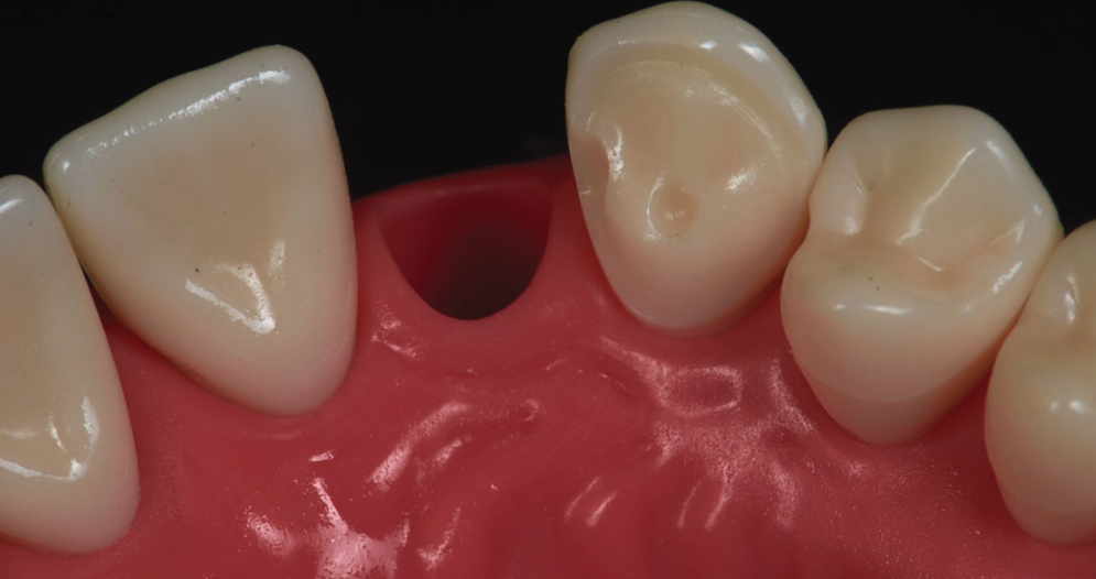 The Bonded SingleWing Zirconia Bridge May 2023 Inside Dental