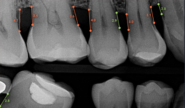 Improving Periodontal Disease Management With Artificial Intelligence