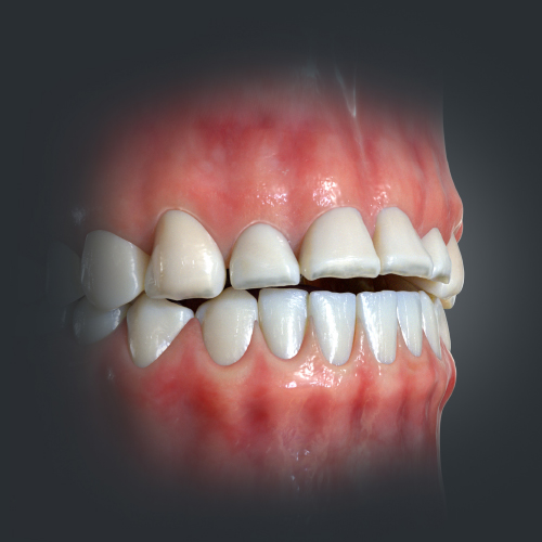 Prevention of Tooth Wear in Patients With Bruxism Ebook Library Image