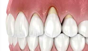 Periodontal Therapy: Patient Outcomes–Based or Profit Center–Based?