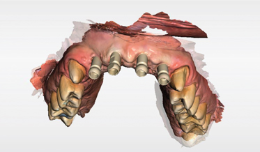 Digital Workflow as an Aid to Complex Multidiscipline Dental Treatment for Improved Esthetics
