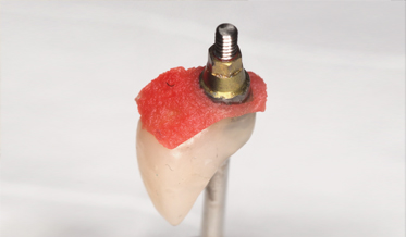 Advances in Esthetic, Immediate Tooth Replacement Therapy Aimed at Improving Clinical Outcomes