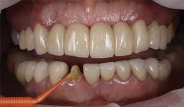 What’s New in Glue: Utilizing Universal Resin Cement for Non-Ideal Situations in Prosthodontics