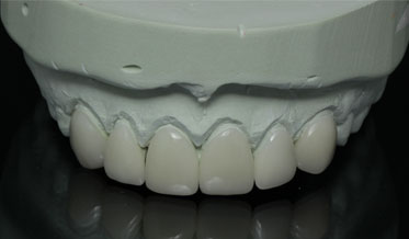 Resin-Based Materials for Indirect Dental Restorations