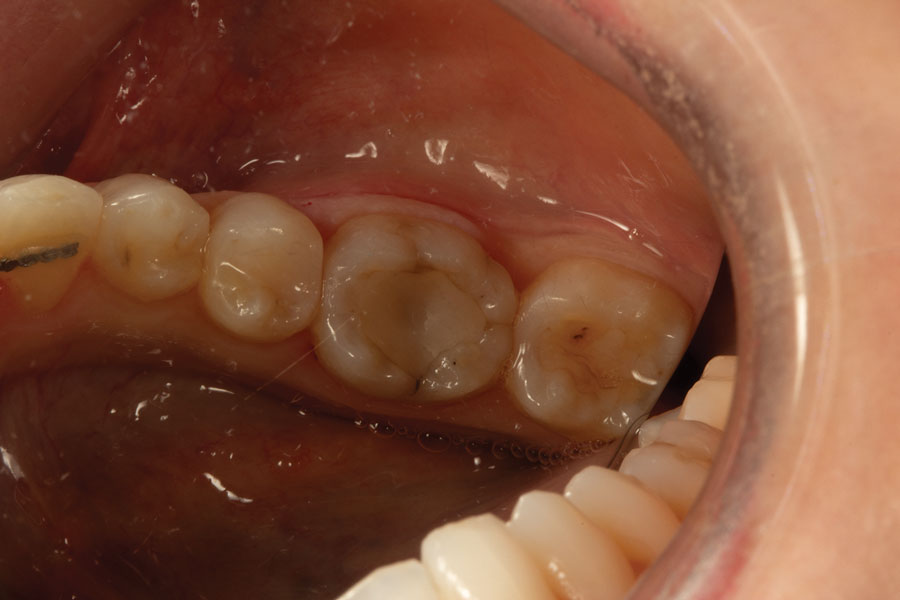 Placing Conservative Posterior Zirconia Restorations November 2023 Inside Dentistry