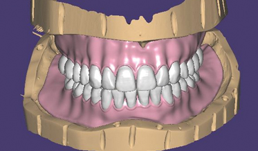 Facially Driven Digital Workflow for Maxillary and Mandibular Milled Implant-Retained Overdentures Using Two Different Unsplinted Attachment Systems