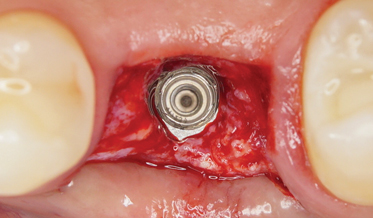 From Minimally Invasive Tooth Extraction to Final Chairside Fabricated Restoration: A Microscopically and Digitally Driven Full Workflow for Single-Implant Treatment
