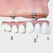 Improve Implant Proficiency With the Full Arch DS Signature™ Workflow