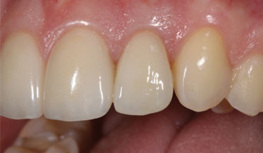 Anterior Tooth Replacement in an Adolescent With a High Smile Line