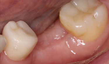 Ensuring Sufficient Attached Gingiva Around an Implant