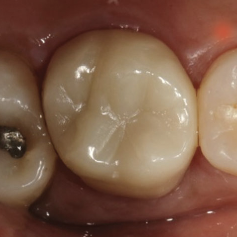 Treating a Fractured Molar