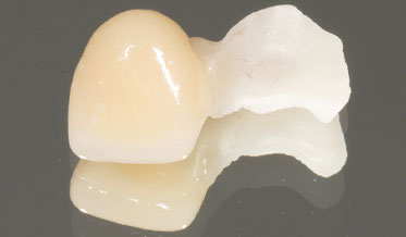 Delivering a Zirconia Resin-Bonded Fixed Partial Denture