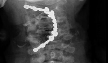 Prosthesis Complications in Elderly Patients: A Case of a Swallowed Overdenture