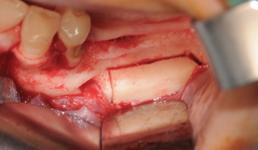 Lateralization of the Inferior Alveolar Nerve in the Rehabilitation of Mandibular Atrophy