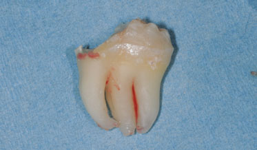 Impacted Mandibular “Double” Third Molar: Fusion or Gemination? A Case Report