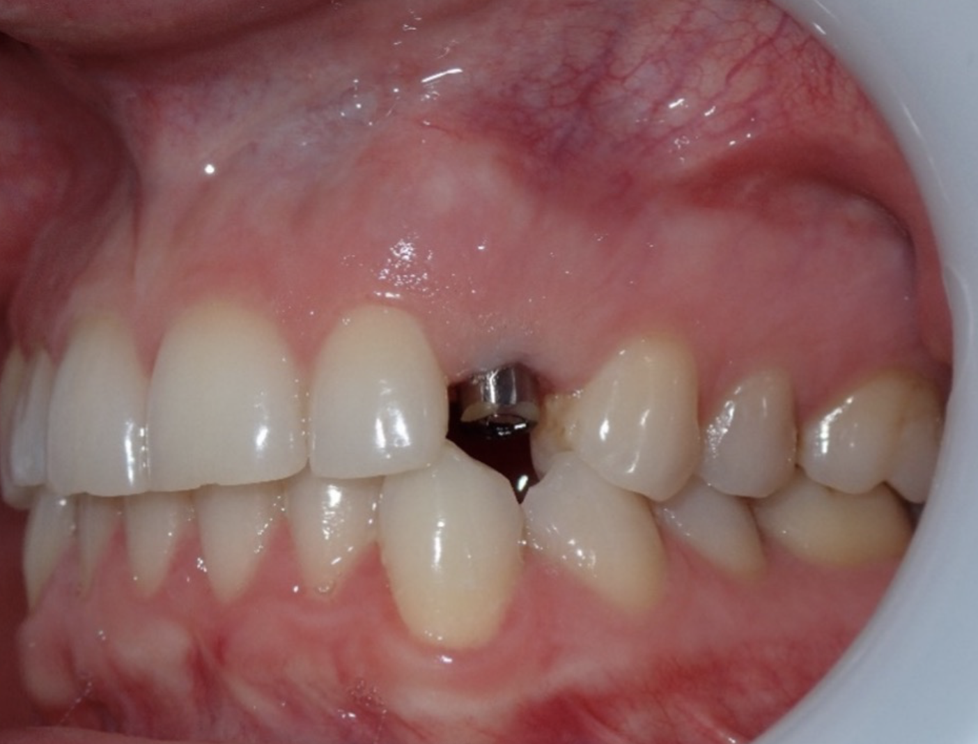 Implant Placement When an Impacted Tooth and Supernumerary Teeth Are Present in the Maxilla