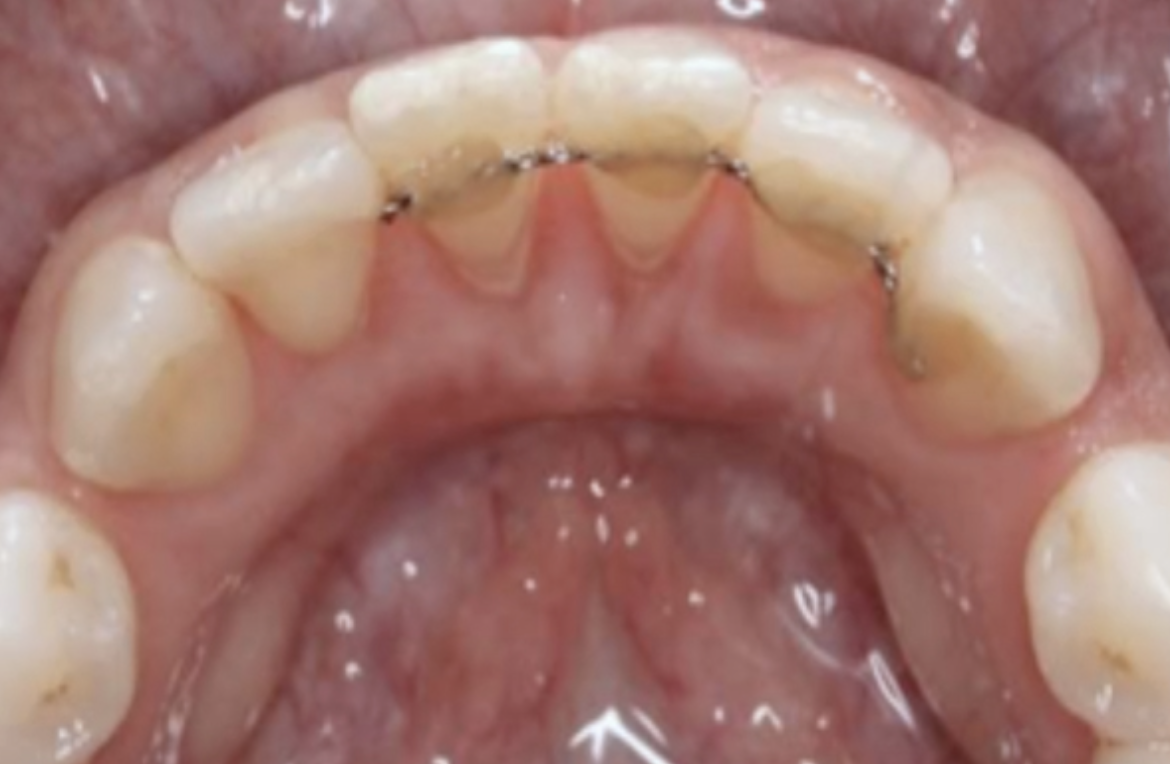 Successful Regenerative Therapy of Periodontal Defects Associated With Tongue Piercing: A Clinical Report