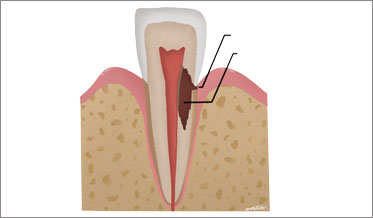 External Cervical Resorption