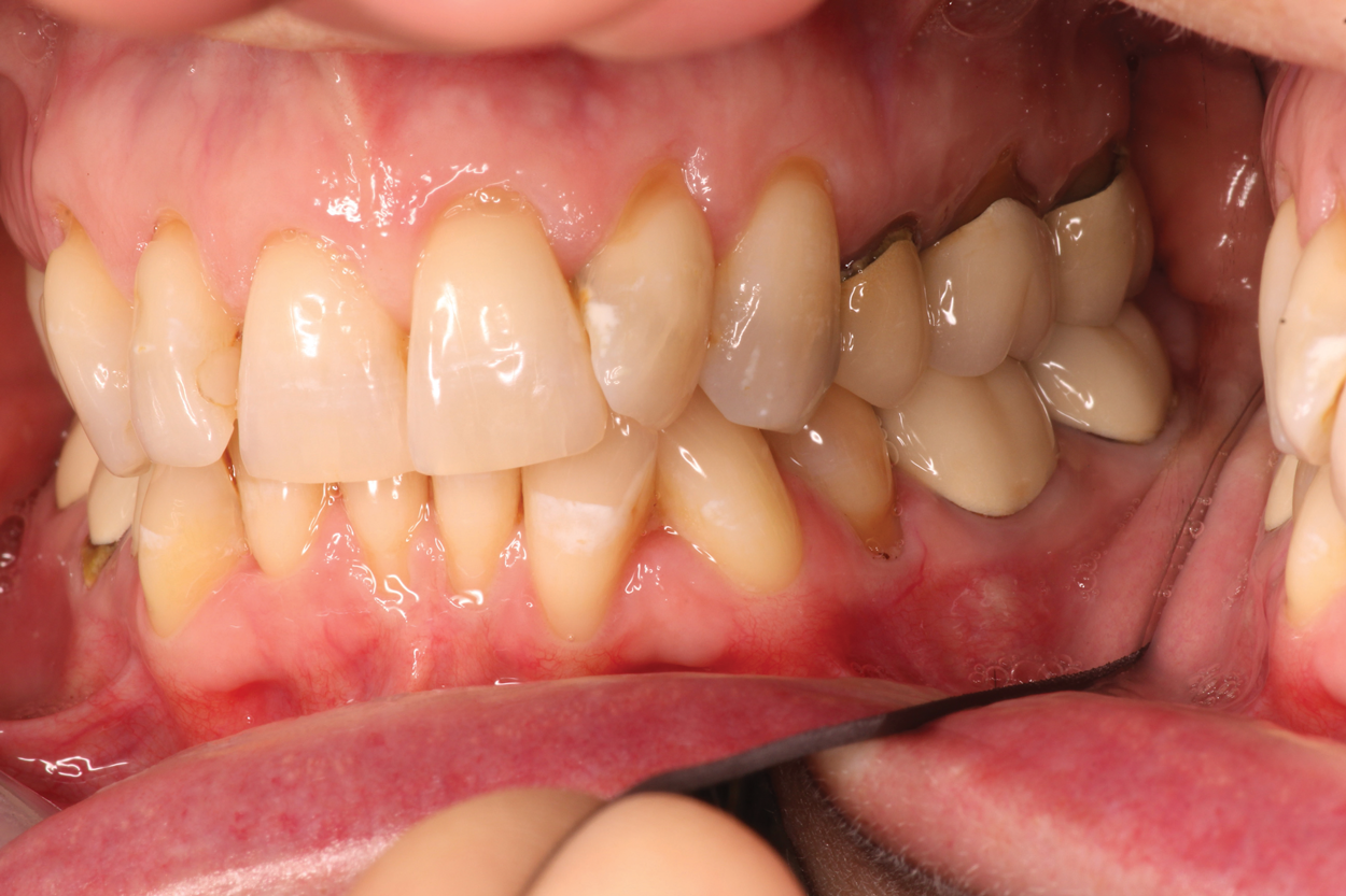 Silver Diamine Fluoride: Its Place in the Hygiene Appointment