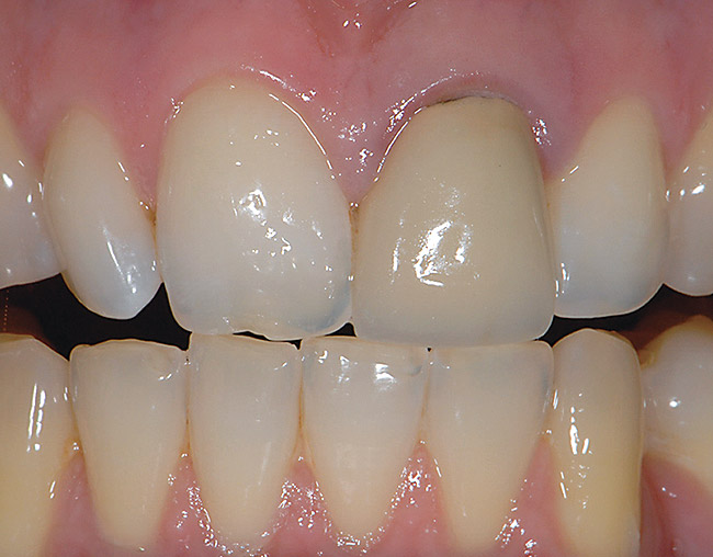 Zirconia Crown Vs Porcelain Fused To Metal