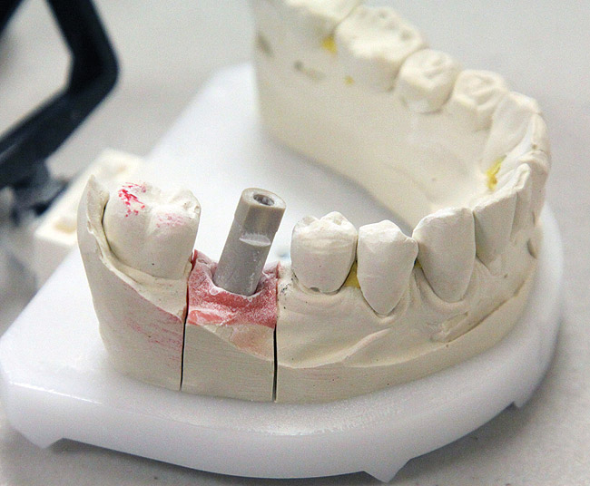 Custom Implant Abutments June 2012 Inside Dental Technology