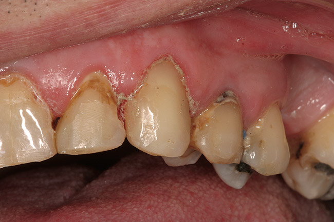 Composites And Whitening How And When To Combine Treatments Special Issues
