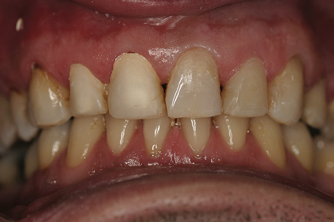Composites And Whitening How And When To Combine Treatments Special Issues