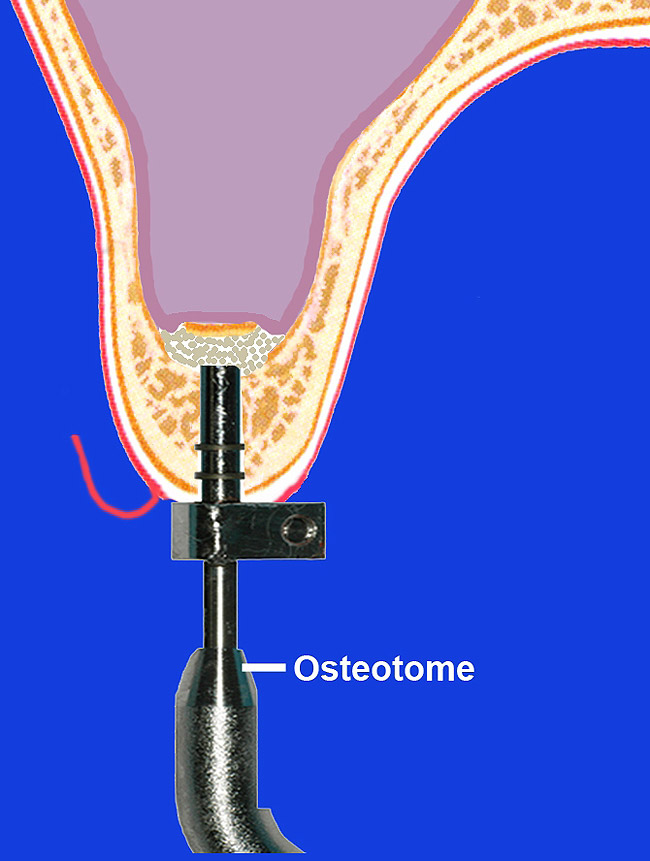 Sinus Floor Elevation With Window Technique Viewfloor.co